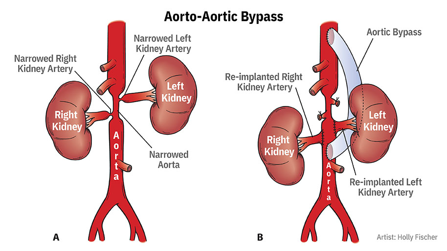 Renovascular hypertension discount