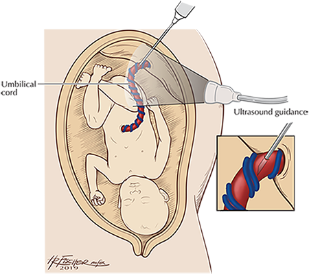 Cordocentesis and Intrauterine Fetal Transfusion