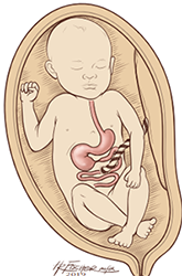 Duodenal Malformations