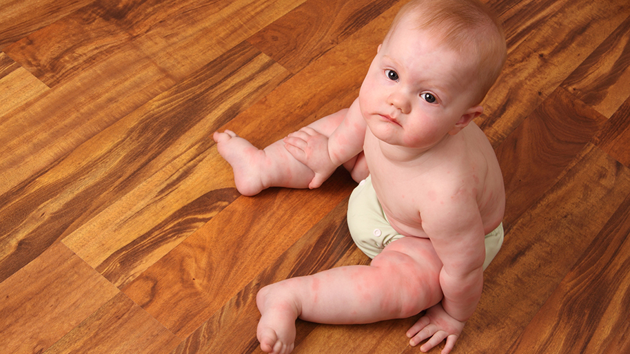Baby with spots of eczema on legs and arms