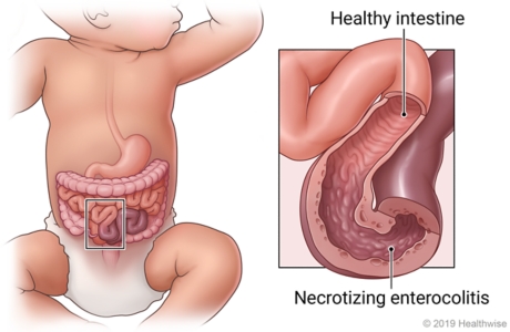 Location of intestines in infant belly with detail of healthy intestine and one with necrotizing enterocolitis