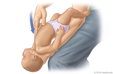 Choking rescue procedure (Heimlich maneuver) with baby faceup