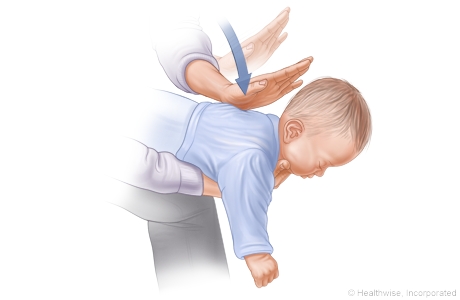 Choking rescue procedure (Heimlich maneuver) with baby facedown