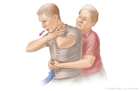 Choking rescue procedure (Heimlich maneuver)