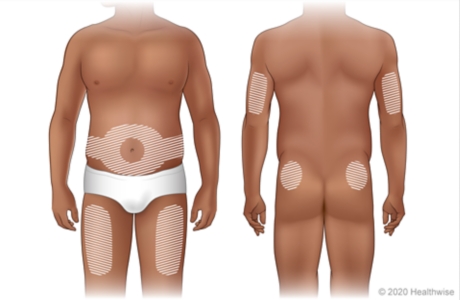 Front and back of body, showing areas where insulin may be injected
