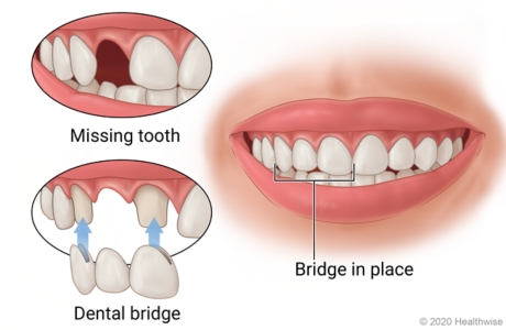 Missing tooth in mouth with teeth on both sides prepped for dental bridge, and then showing bridge in place.