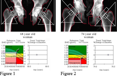 DXA of normal hipbones and DXA of osteoporosis in hipbones