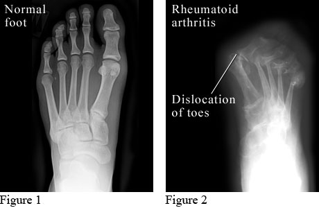 X-ray images of a normal foot and a foot with rheumatoid arthritis