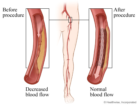 Peripheral Arterial Angioplasty | CS Mott Children's Hospital | Michigan Medicine Peripheral Arterial Angioplasty | CS Mott Children's Hospital | Michigan Medicine