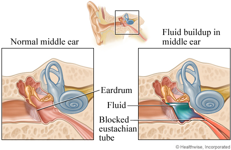 Normal middle ear and fluid buildup in the middle ear