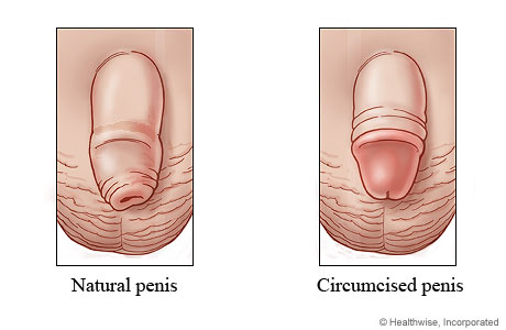 Natural penis and circumcised penis