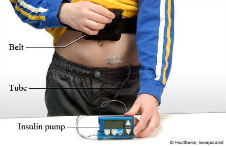 Insulin pump, sensor, and belt