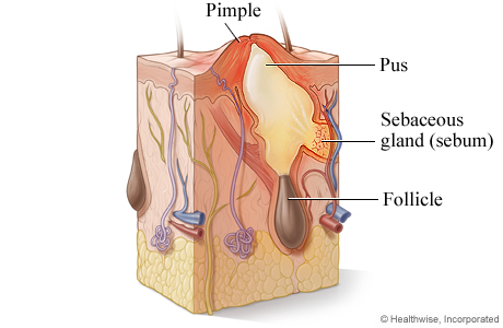 Infected gland and pimple