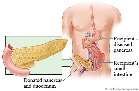 Picture of pancreas transplant