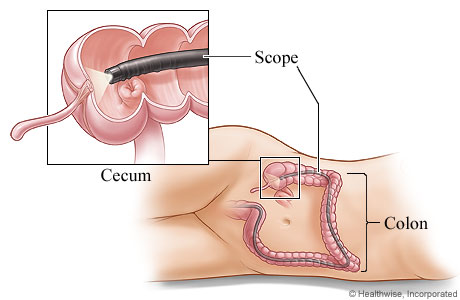 Colonoscope in the colon