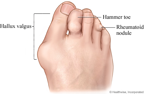 Picture of rheumatoid arthritis in the foot