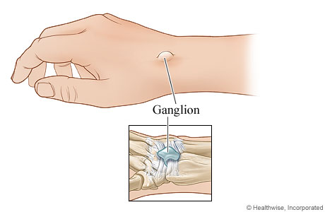 Dorsal wrist ganglion