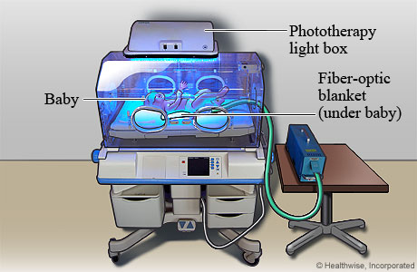 Baby getting phototherapy for jaundice