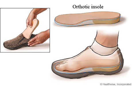 View of foot inside shoe resting on orthotic insole, with detail of insole placement in shoe