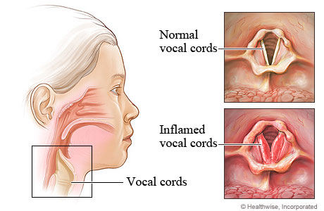 Inflamed vocal cords in laryngitis