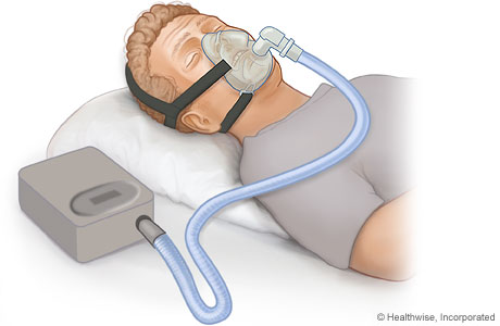 Continuous positive airway pressure (CPAP) device