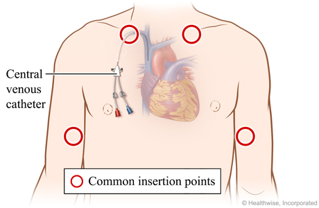 Common catheter insertioni points