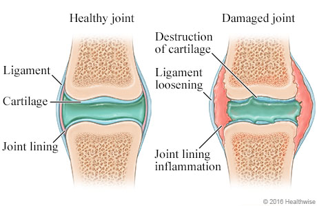 Healthy joint compared to damaged joint