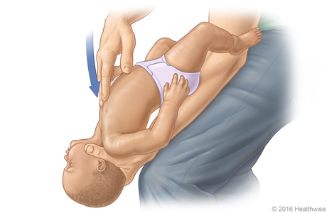 Picture D: Position of baby on thigh for Heimlich maneuver, showing position and direction of chest thrusts