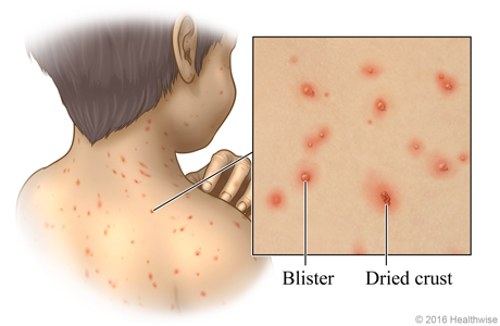 Typical chickenpox rash on back of a child, with close-up showing blisters and crusted sores