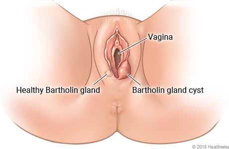 Female genital area, showing a healthy Bartholin gland and a Bartholin gland cyst