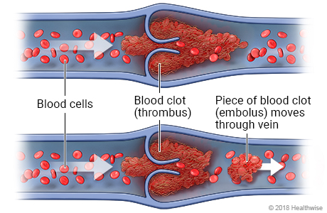 Cross-section of a vein, showing blood cells, a blood clot (thrombus), and a piece of the blood clot (embolus) that has broken off the thrombus and is moving through the vein
