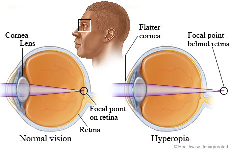 Cross sections of the eye for normal vision and for farsightedness