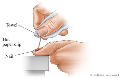How to drain blood from under a nail