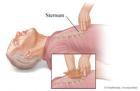 CPR on adult, showing where to place hands on sternum for chest compressions
