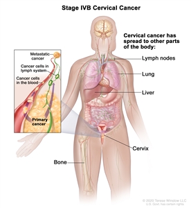 Cervical Cancer Treatment Pdq Treatment Patient Information Nci Cs Mott Children S Hospital Michigan Medicine