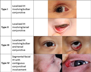 hemangiomas tumoral