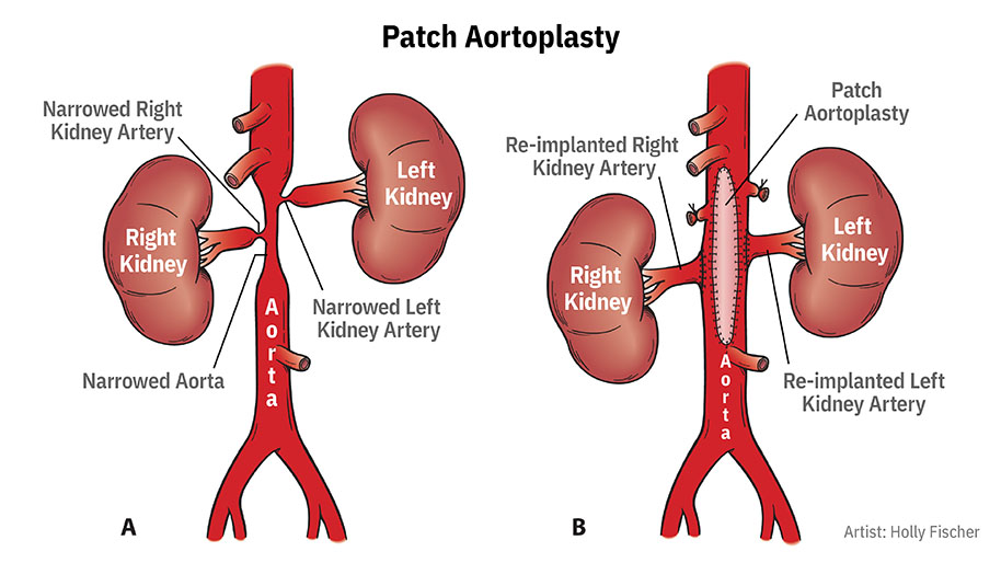 Aortoplasty image