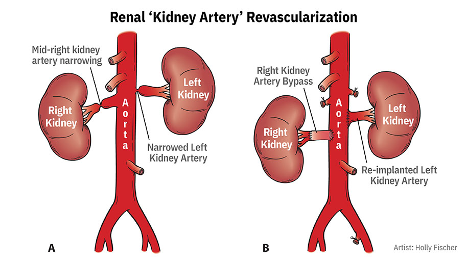 Renal Kidney Artery Revascularization figure