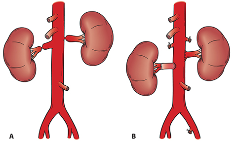 renal renovascular surgical hypertension pediatric conditions treatment revascularization artery figure