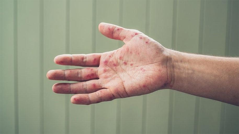 Hand with blisters from hand foot and mouth disease