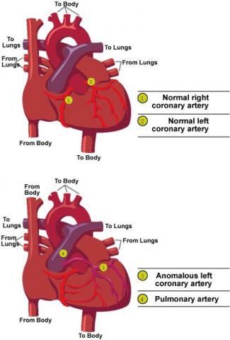 Anomalous Left Coronary Artery CS Mott Children S Hospital