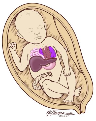Right-Sided Congenital Diaphragmatic Hernia