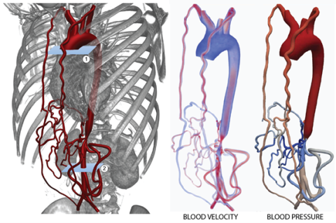 Computational analysis of blood flow and pressure in a pediatric patient with mid-aortic syndrome