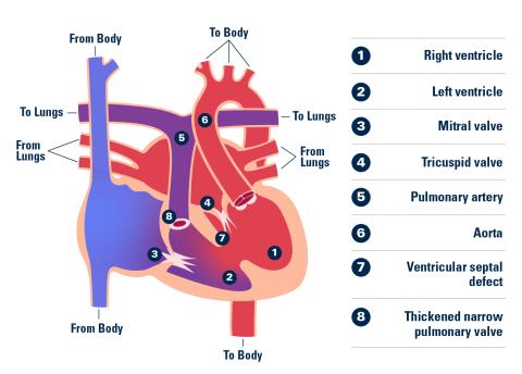 Corrected Transposition of the Great Arteries graphic