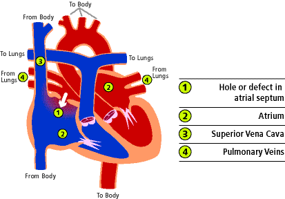 Pathophysiology Of Atrial Septal Defect In Flow Chart