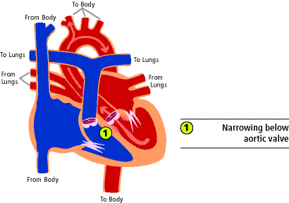 Aortic stenosis, subvalvar