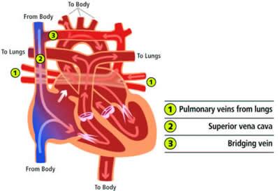 image 1 of 3 Anomalous Pulmonary Venous Return