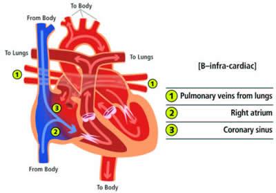 2 of 3 images Anomalous Pulmonary Venous Return