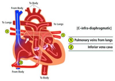 image 3 of 3 Anomalous Pulmonary Venous Return