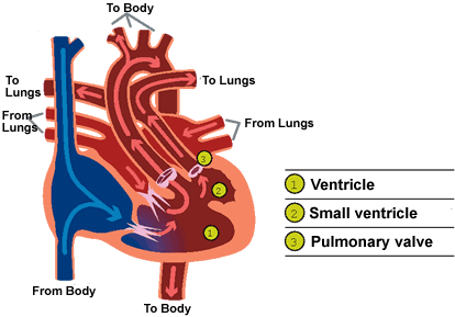 Complex single ventricle illustration